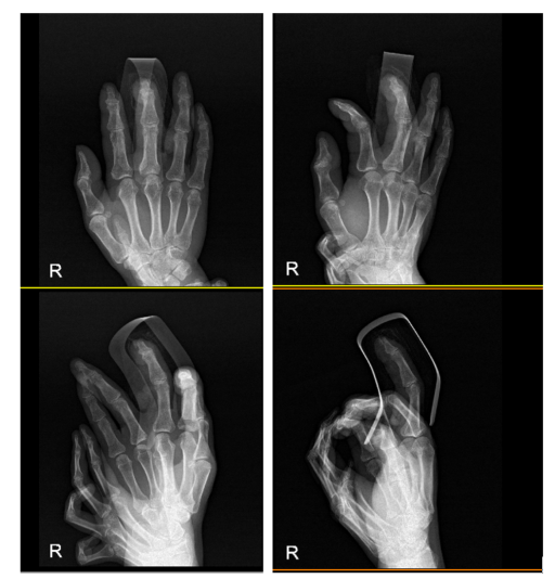 수지 말단부 절단에 시행한 동측 역행성 유경피판술 증례 (Homodigital Reverse Island Flap for Fingertip Amputation) 관련 이미지 10