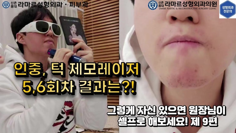 [성형외과 전문의의 셀프시술 제9편] 인중, 아래턱 제모 5,6회차 결과 공개! 관련 이미지 24