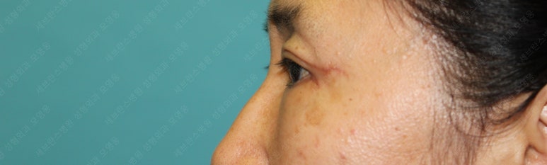 55세 여성, 상안검 및 하안검 성형술 증례 (55/F Upper & lower blepharoplasty) 관련 이미지 16