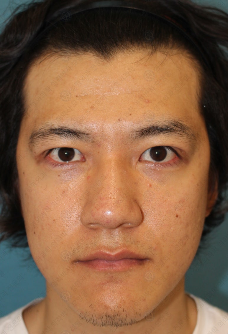 27세 남성 무쌍(속쌍)눈매교정 (27/M Ptosis correction with double lid plasty) 관련 이미지 21