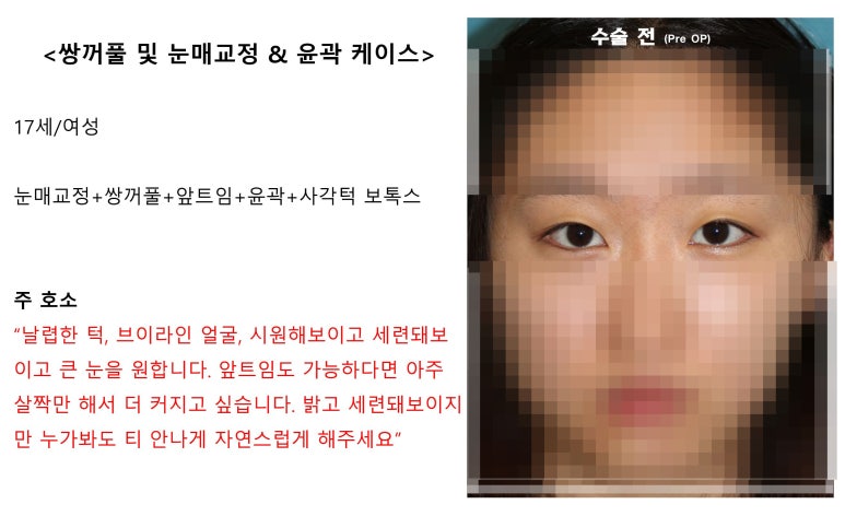 17세 여성, 쌍꺼풀+앞트임(DEO+Medial epicanthoplasty) 관련 이미지 13