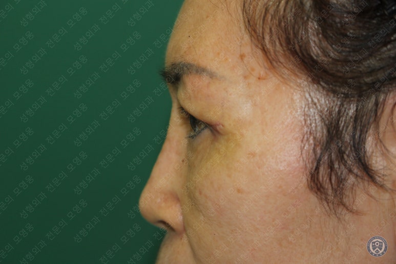 64세 여성 상안검성형술+눈매교정 (64/F Upper blepharoplasty with ptosis correction) 관련 이미지 14