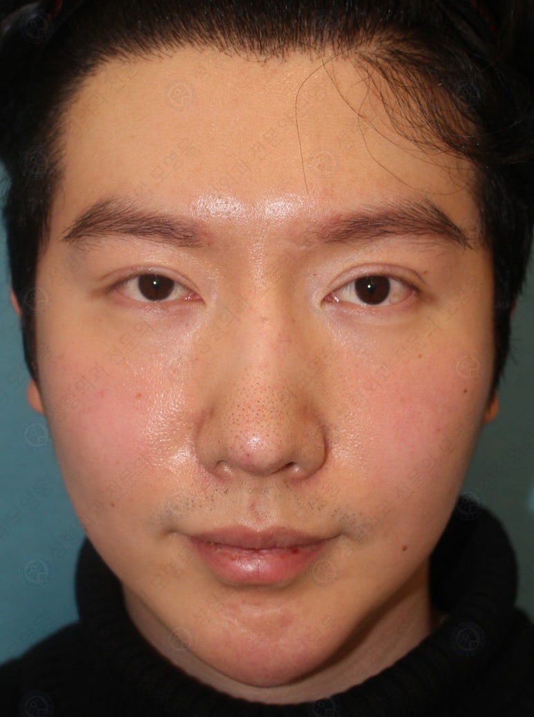 29세 남자, 소시지 쌍꺼풀 두줄따기로 낮추기 (쌍꺼풀 재수술) 관련 이미지 12