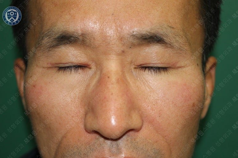 남자눈성형: 무쌍눈매교정 (Blephroptosis correction-levator aponeurosis advancement) 관련 이미지 31