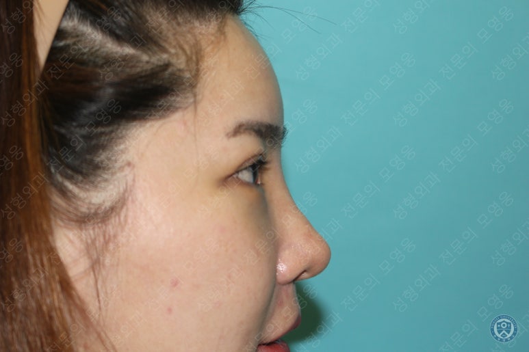 28세 여성 두줄따기, 눈밑지(28/F D.E.O & transconjunctival septal fat redraping) 관련 이미지 17