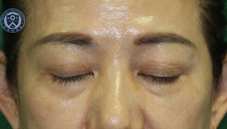 59세 여성, 그레이브스 안병증이 있는 돌출눈 중년 여성 하안검 성형술 (Lower blepharoplasty in Graves 관련 이미지 6