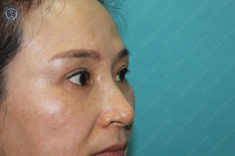 49세 여성, 토안이 있는 중년여성의 상안검성형술 (49/F, Upper blepharoplasty with lagophthalmos correction& LP) 관련 이미지 39