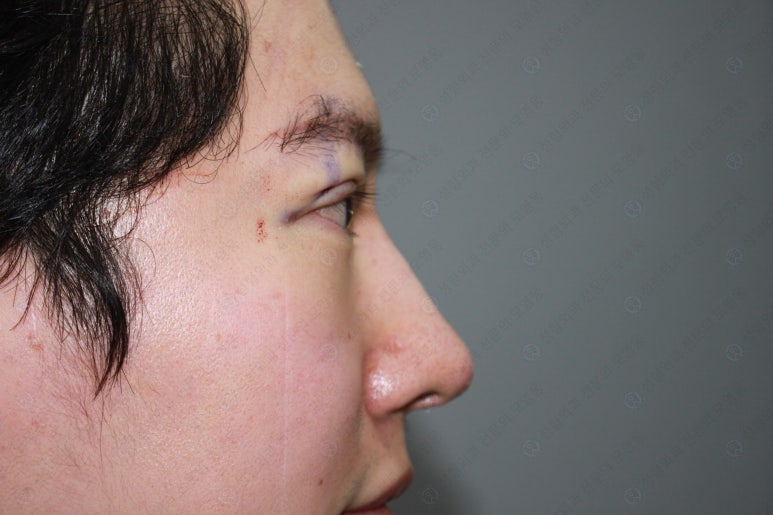29세 남자, 소시지 쌍꺼풀 두줄따기로 낮추기 (쌍꺼풀 재수술) 관련 이미지 85