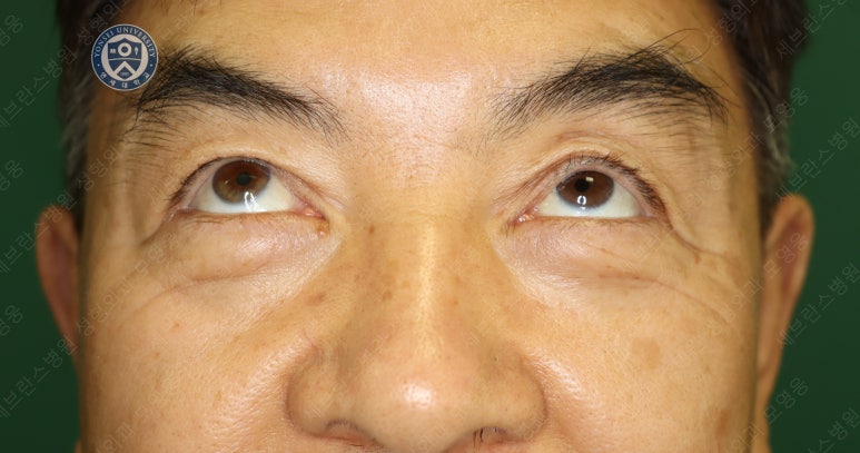68세 남성, 하안검 성형술 및 안검외반 교정 증례(68/M Lower blepharoplasty & Ectropion correction with triamcinolone) 관련 이미지 3
