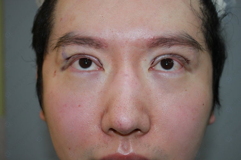 29세 남자, 소시지 쌍꺼풀 두줄따기로 낮추기 (쌍꺼풀 재수술) 관련 이미지 81