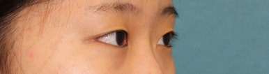 17세 여성, 쌍꺼풀+앞트임(DEO+Medial epicanthoplasty) 관련 이미지 7