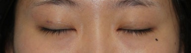 17세 여성, 쌍꺼풀+앞트임(DEO+Medial epicanthoplasty) 관련 이미지 32