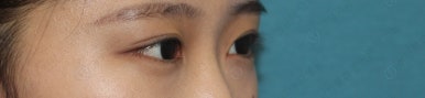 17세 여성, 쌍꺼풀+앞트임(DEO+Medial epicanthoplasty) 관련 이미지 50