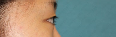 17세 여성, 쌍꺼풀+앞트임(DEO+Medial epicanthoplasty) 관련 이미지 8