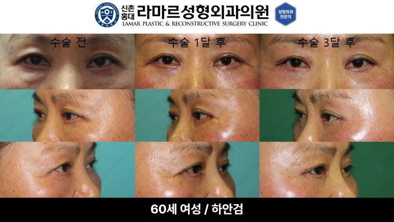 30대~80대 눈 수술 케이스 : 하안검성형술 전후 사진 모음 관련 이미지 45