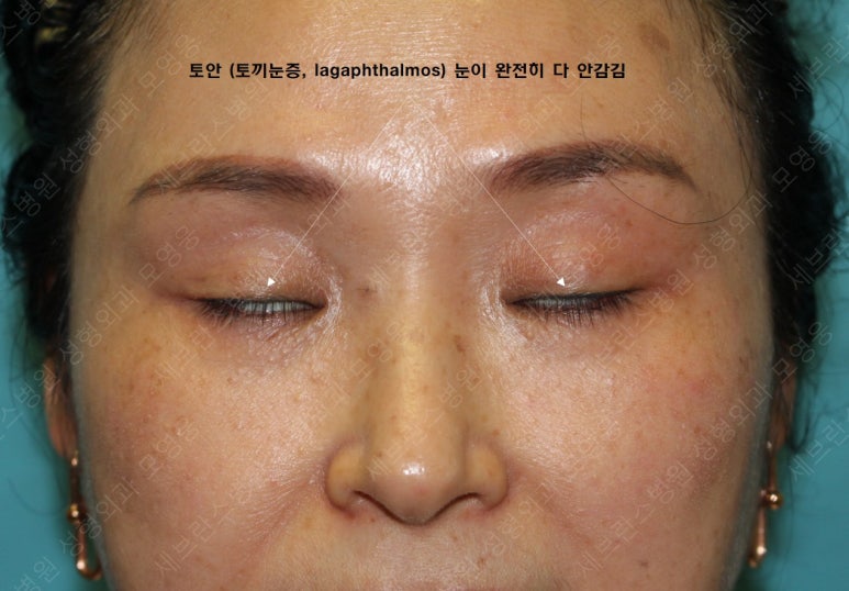 49세 여성, 토안이 있는 중년여성의 상안검성형술 (49/F, Upper blepharoplasty with lagophthalmos correction& LP) 관련 이미지 11