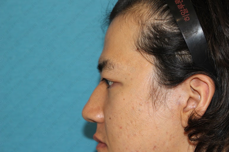 27세 남성 무쌍(속쌍)눈매교정 (27/M Ptosis correction with double lid plasty) 관련 이미지 34