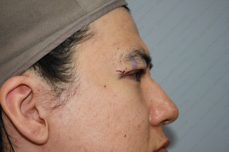 27세 남성 무쌍(속쌍)눈매교정 (27/M Ptosis correction with double lid plasty) 관련 이미지 20