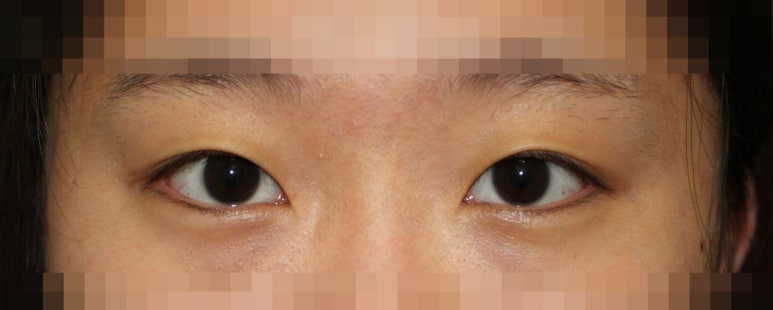 17세 여성, 쌍꺼풀+앞트임(DEO+Medial epicanthoplasty) 관련 이미지 4