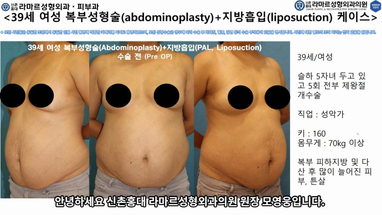 '복부성형술+지방흡입(Abdominoplasty+PAL)' 으로 뱃살 끝장내기! 관련 이미지 23