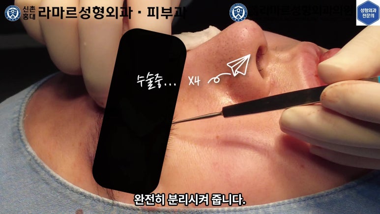 29세 남자, 소시지 쌍꺼풀 두줄따기로 낮추기 (쌍꺼풀 재수술) 관련 이미지 33
