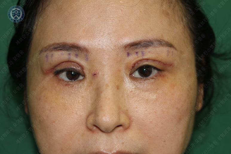 49세 여성, 토안이 있는 중년여성의 상안검성형술 (49/F, Upper blepharoplasty with lagophthalmos correction& LP) 관련 이미지 17
