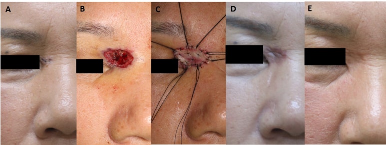 Medicine - Comparison of the recurrence rate of 3 treatmentmodalities for BD in an aging city 관련 이미지 12