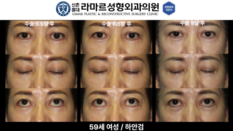 30대~80대 눈 수술 케이스 : 하안검성형술 전후 사진 모음 관련 이미지 49