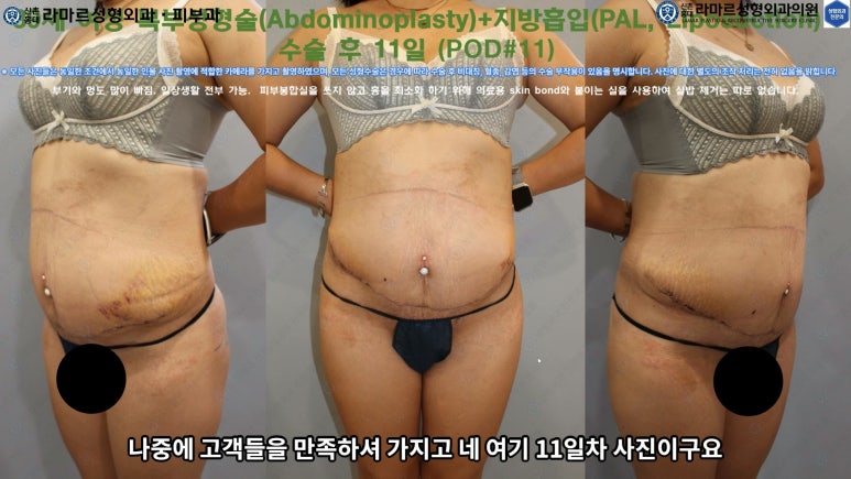 '복부성형술+지방흡입(Abdominoplasty+PAL)' 으로 뱃살 끝장내기! 관련 이미지 46