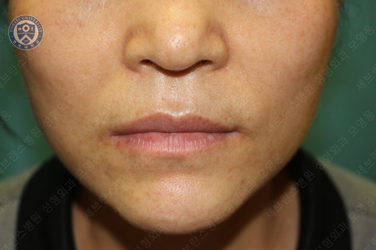 55세 여성, 이중평면 안면거상(55/F, Dual-plane full facelift) 관련 이미지 43