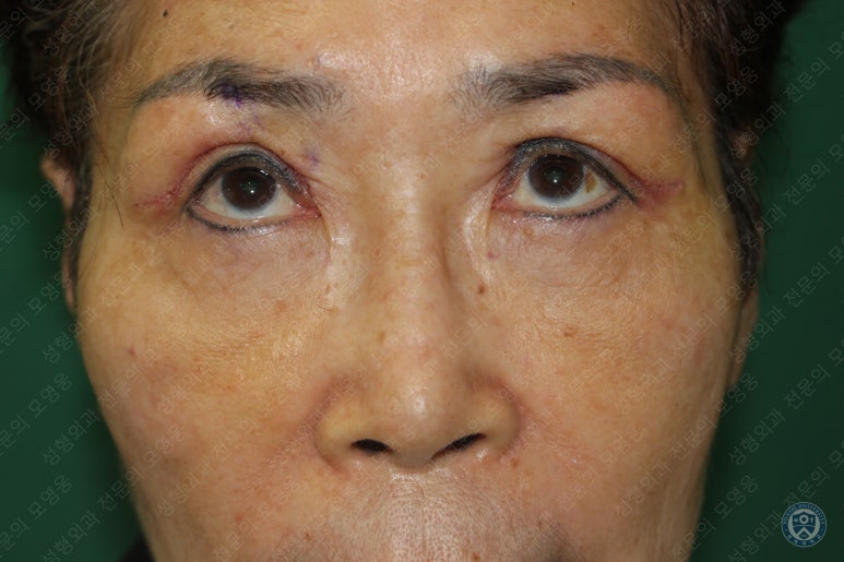 64세 여성 상안검성형술+눈매교정 (64/F Upper blepharoplasty with ptosis correction) 관련 이미지 13