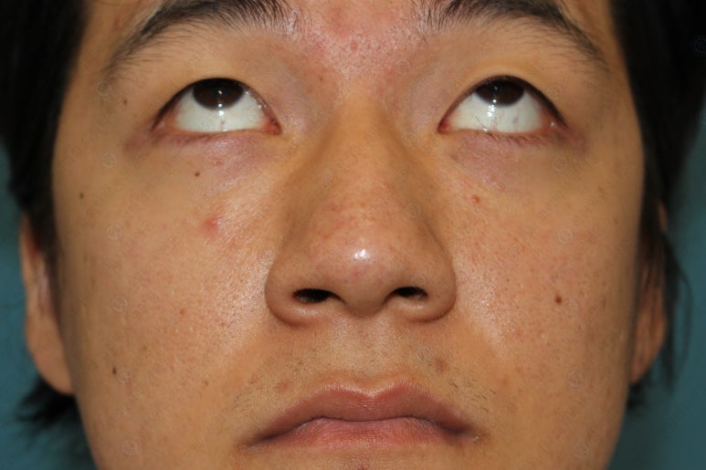 27세 남성 무쌍(속쌍)눈매교정 (27/M Ptosis correction with double lid plasty) 관련 이미지 6