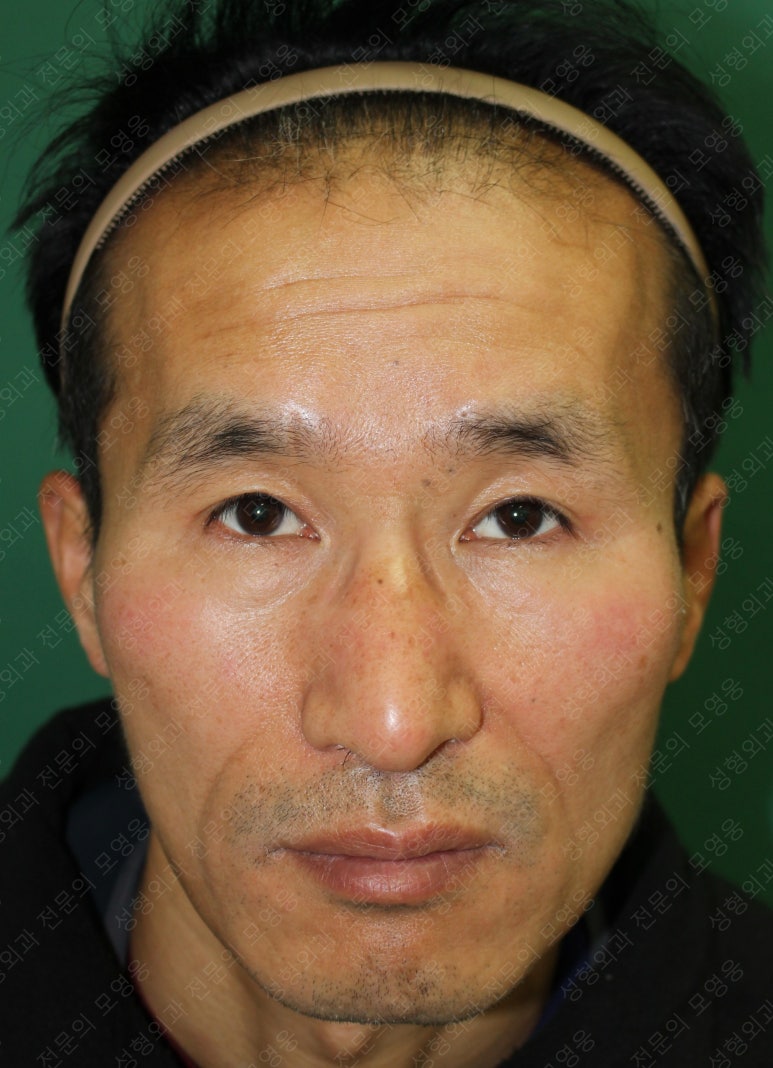 남자눈성형: 무쌍눈매교정 (Blephroptosis correction-levator aponeurosis advancement) 관련 이미지 37