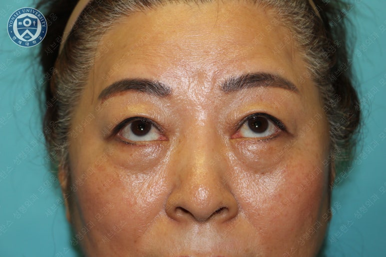 60세 여성, 상안검 및 하안검 성형술 증례 (60/F Upper & lower blepharoplasty) 관련 이미지 5