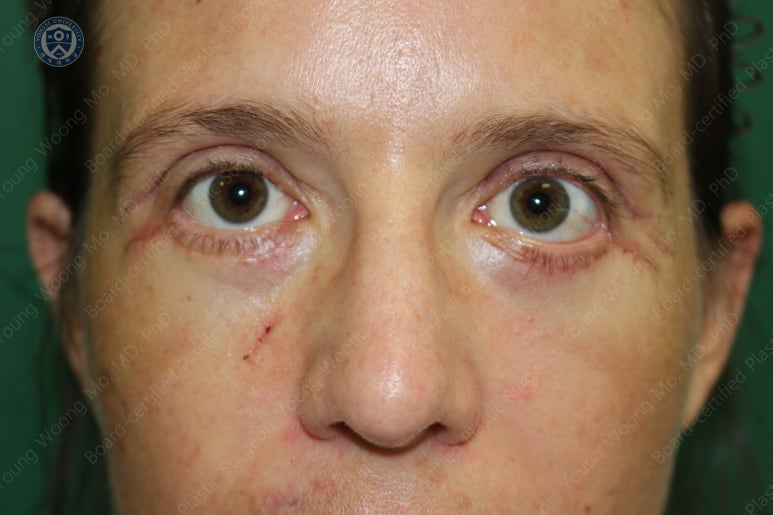 38세 서양 백인 여성, 쌍꺼풀 수술과 눈매교정 및 하안검성형술 (38/F Upper&lower blepharoplasty with levator plication) 관련 이미지 22