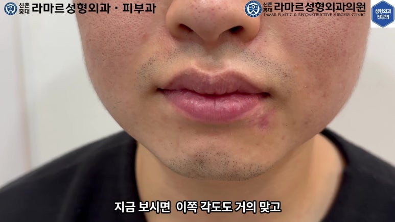 개에 물려 입술 1/3이 뜯긴 19세 남자분 치료 및 흉터 성형수술& 레이저 후기....! 관련 이미지 47