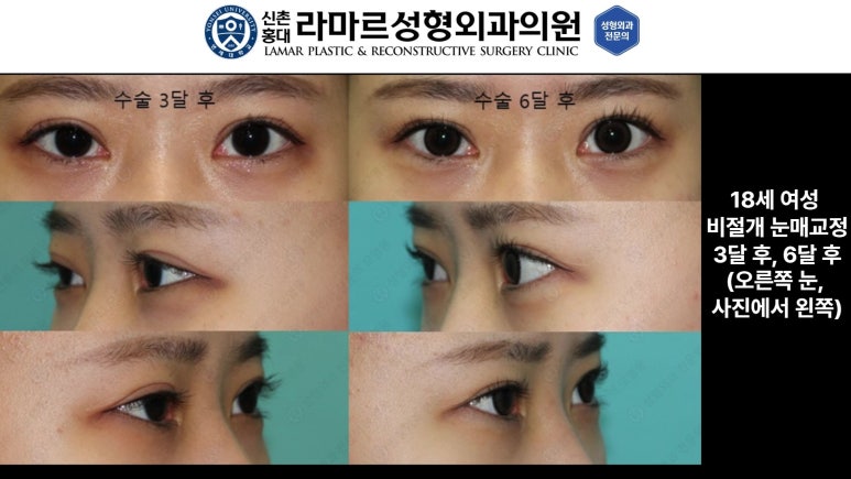 10대~30대 눈 수술 케이스 : 대표원장님 쌍꺼풀 전후 사진 모음 관련 이미지 8