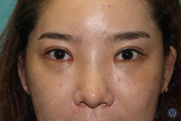 28세 여성 두줄따기, 눈밑지(28/F D.E.O & transconjunctival septal fat redraping) 관련 이미지 11