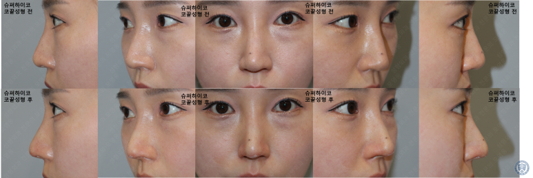 31세 여성 최소침습 하이코 코끝성형 관련 이미지 3