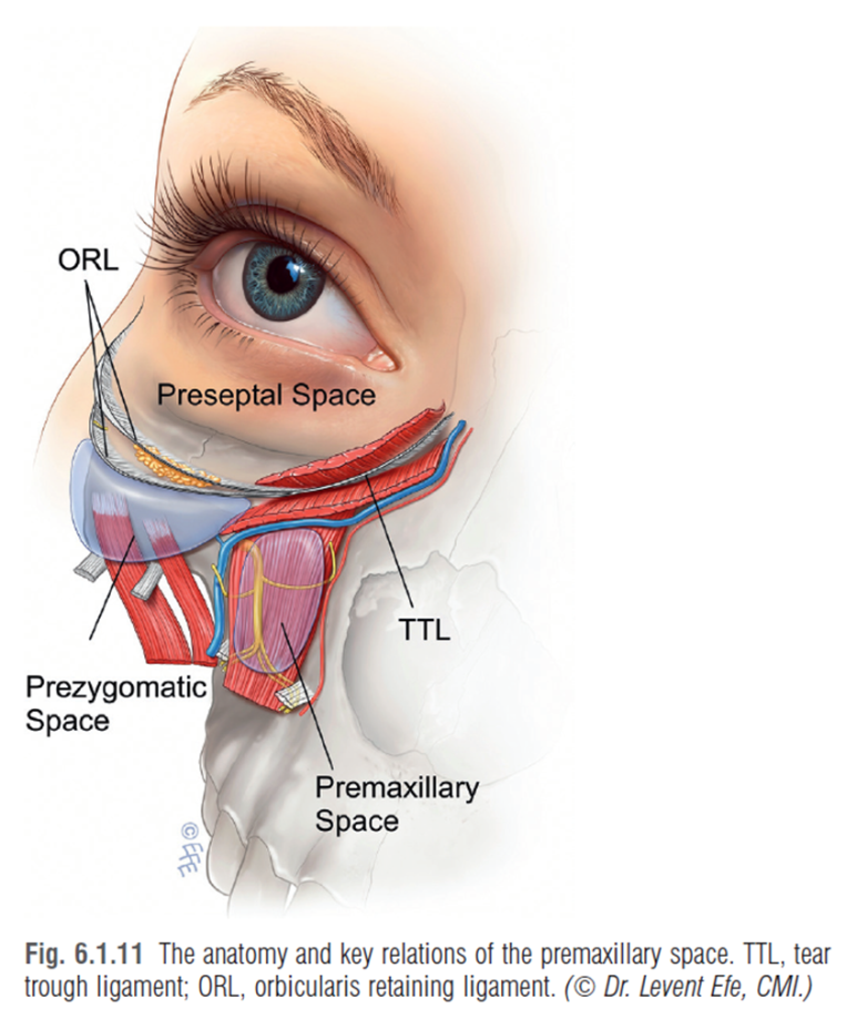 28세 여성, 눈밑지방재배치(눈밑지, 28/F Transconjunctival septal fat redraping-internal fixation technique) 관련 이미지 8