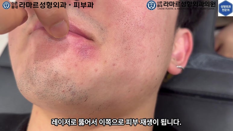 개에 물려 입술 1/3이 뜯긴 19세 남자분 치료 및 흉터 성형수술& 레이저 후기....! 관련 이미지 81