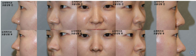 27세 여성 최소침습 코끝성형 시술영상 관련 이미지 2