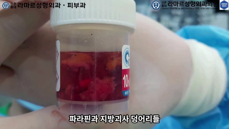 파라핀 필러 입 안 절개로 흉터없이 빼내기! 관련 이미지 88