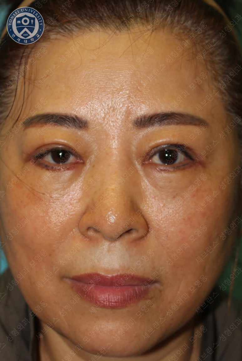 60세 여성, 상안검 및 하안검 성형술 증례 (60/F Upper & lower blepharoplasty) 관련 이미지 14