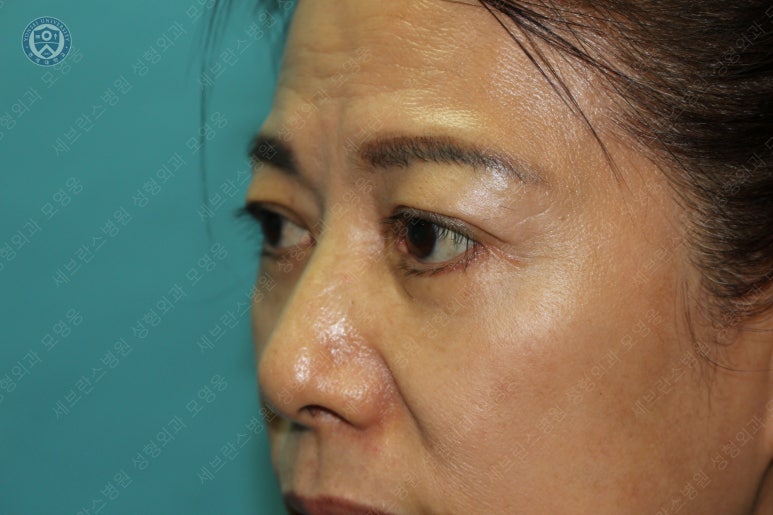 59세 여성, 그레이브스 안병증이 있는 돌출눈 중년 여성 하안검 성형술 (Lower blepharoplasty in Graves 관련 이미지 38