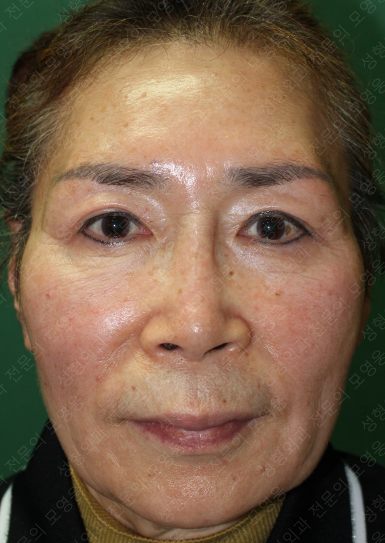 64세 여성 상안검성형술+눈매교정 (64/F Upper blepharoplasty with ptosis correction) 관련 이미지 34