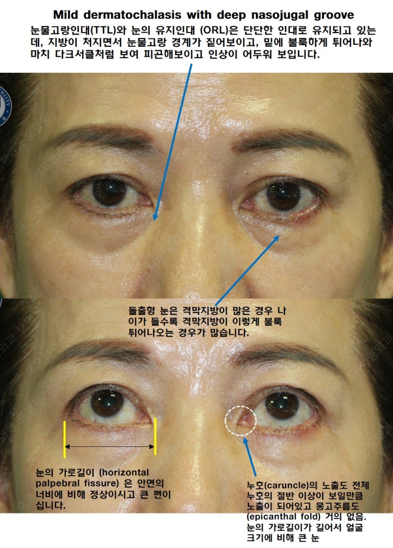 59세 여성, 그레이브스 안병증이 있는 돌출눈 중년 여성 하안검 성형술 (Lower blepharoplasty in Graves 관련 이미지 8