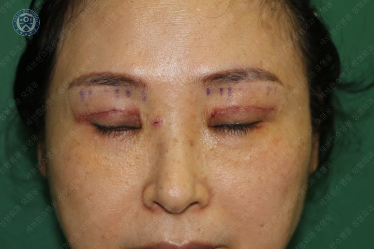 49세 여성, 토안이 있는 중년여성의 상안검성형술 (49/F, Upper blepharoplasty with lagophthalmos correction& LP) 관련 이미지 18