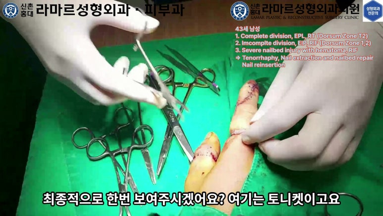 손가락 힘줄 손상 및 열상, 손톱 바닥 열상 처치 (Extensor tendon repair and nailbed injury treatment) 관련 이미지 31