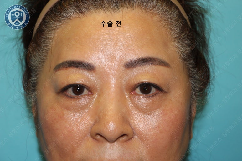 60세 여성, 상안검 및 하안검 성형술 증례 (60/F Upper & lower blepharoplasty) 관련 이미지 3
